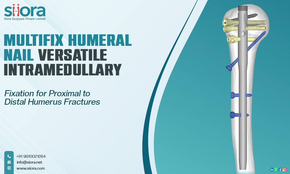 Multifix Humeral Nail: Versatile Intramedullary Fixation for Proximal to Distal Humerus&nbsp;Fractures